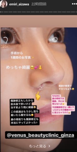 元「歌舞伎町イチの嬢王」愛沢えみり、“鼻の骨削り整形”写真を公開「本当にやってよかった」