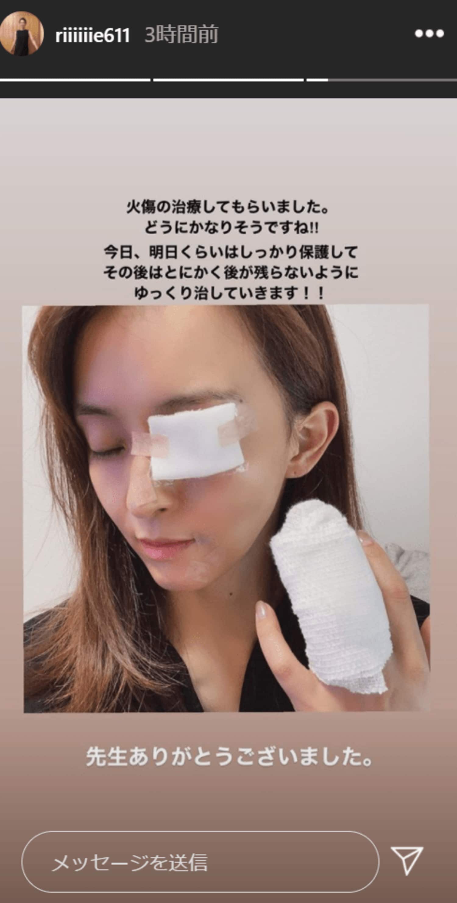 田中理恵、「顔面やけど」で病院へ　“ユッキーナ炎上”に続くW災難!!の画像